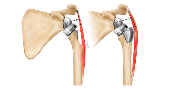 Reverse shoulder replacement