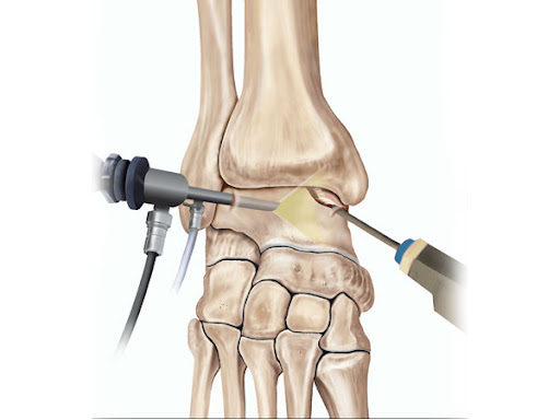 Ankle Arthroscopy