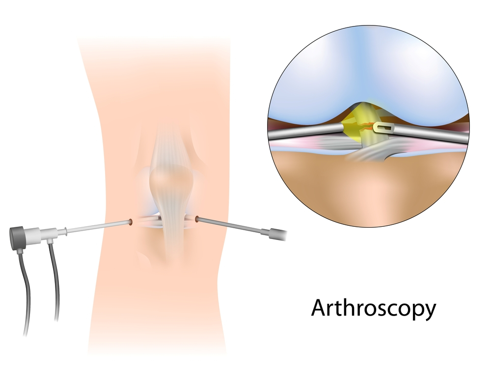 knee arthroscopy treatment