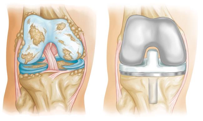 knee reconstruction surgery