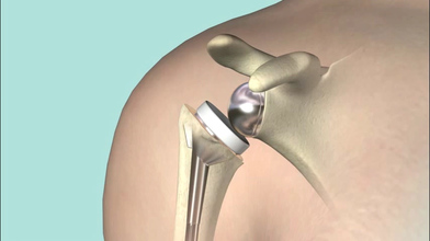 Reverse shoulder replacement