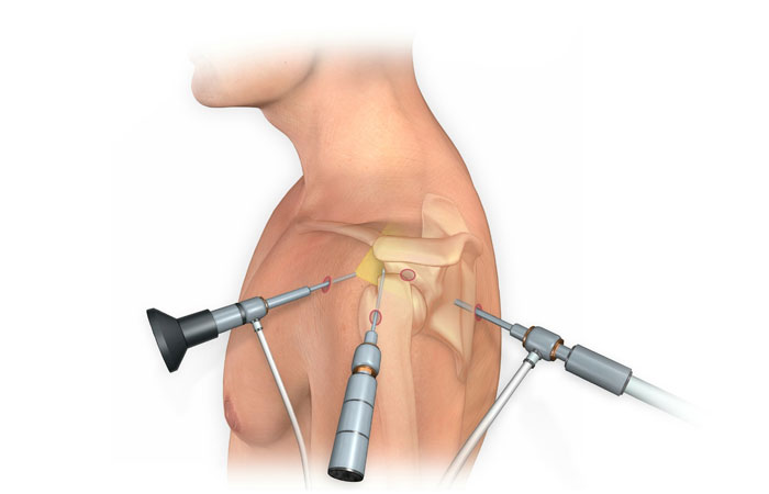 Shoulder Arthroscopy