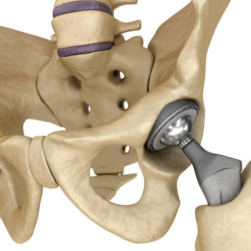 total hip replacement