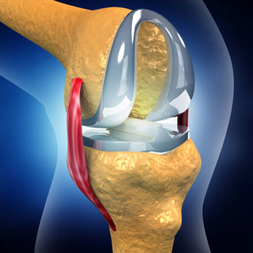 total knee replacement